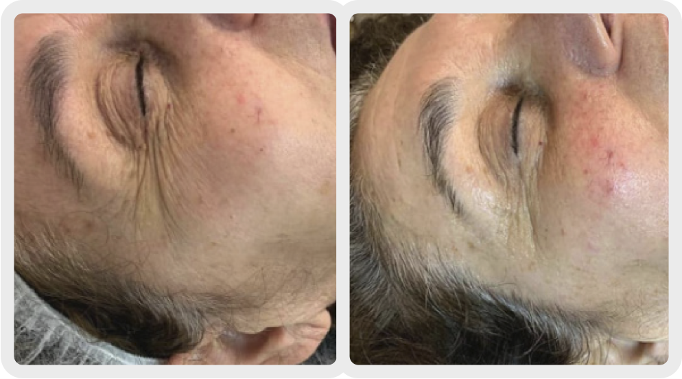 Before and after fine lines and wrinkles