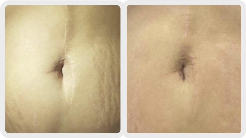 Before and after stretch marks